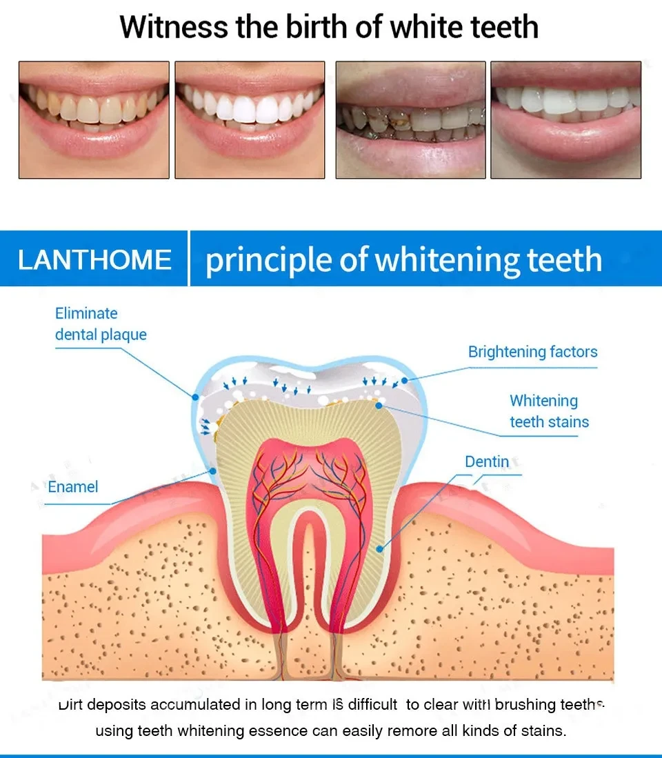 LANTHOME Dental Pen
