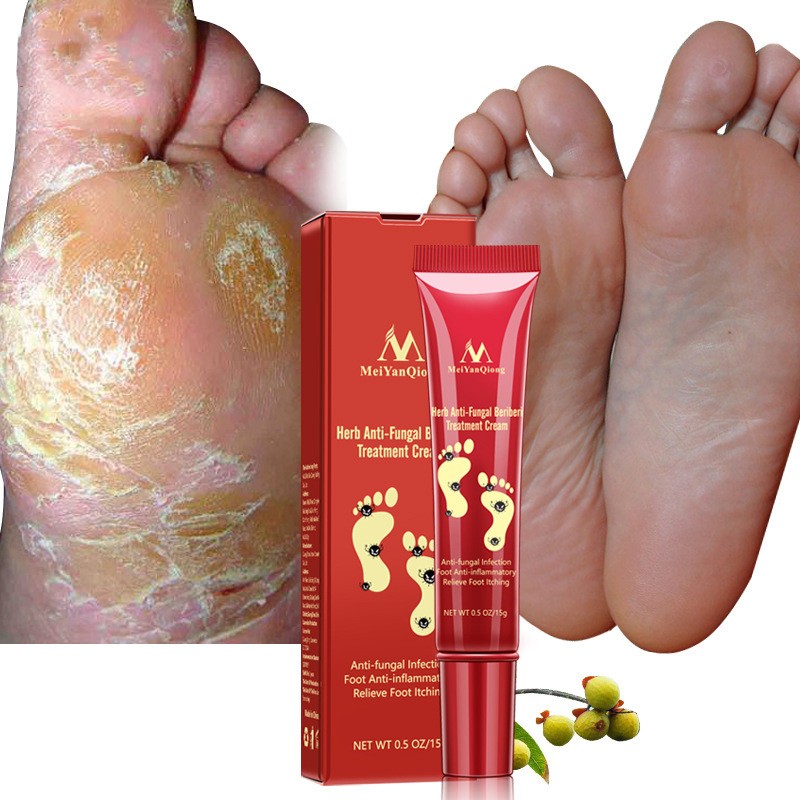 Herb Anti-Fungal Beriberi Treatment Cream