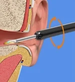 Wi -Fi visible wax elimination spoon-1080P HD load otoscope