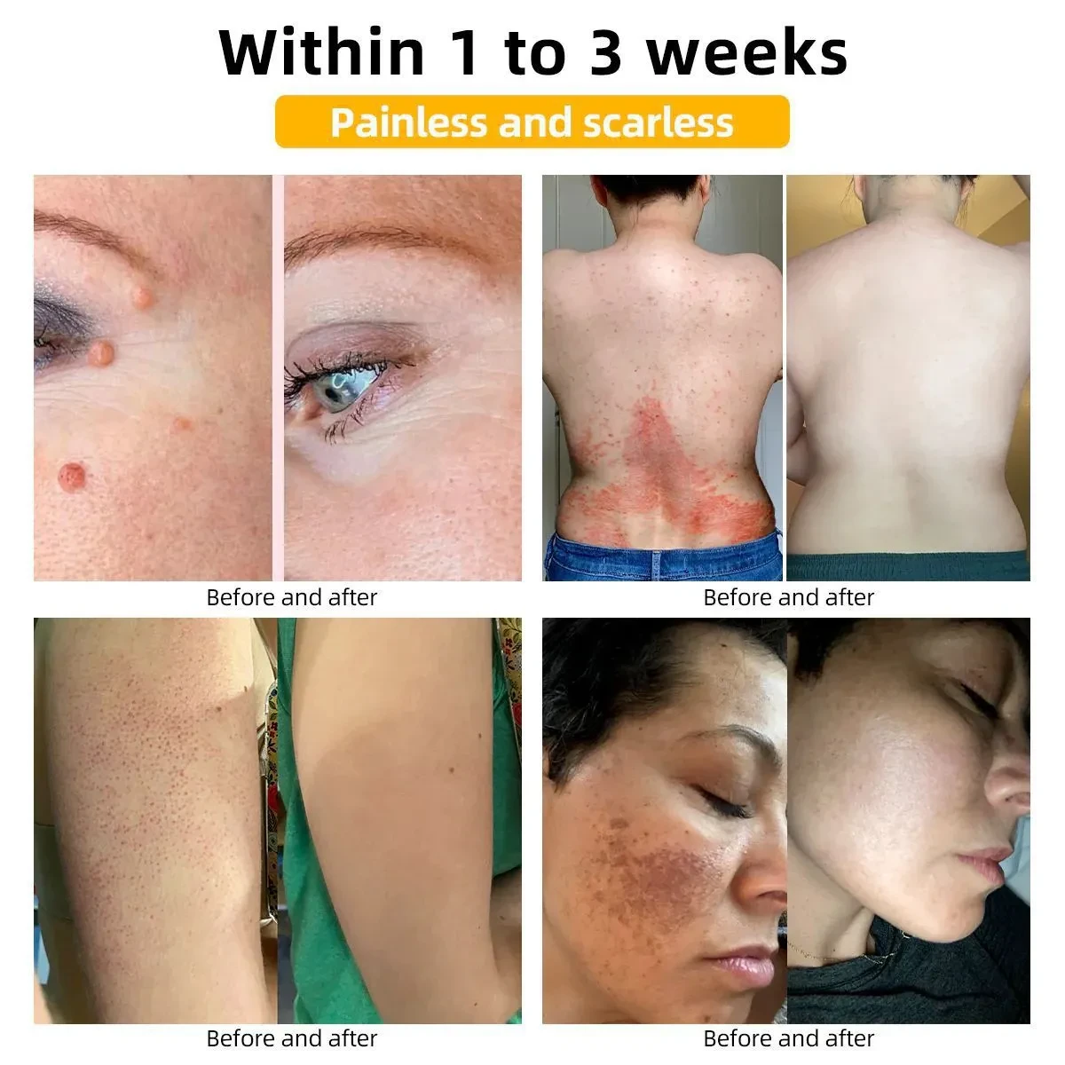 Mole And Wart Cream Fade Skin Cleaning