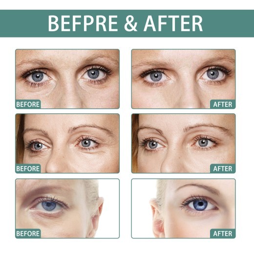 Anti-wrinkle Eye Cream Protects Skin Around Eyes And Reduces Dark Spots