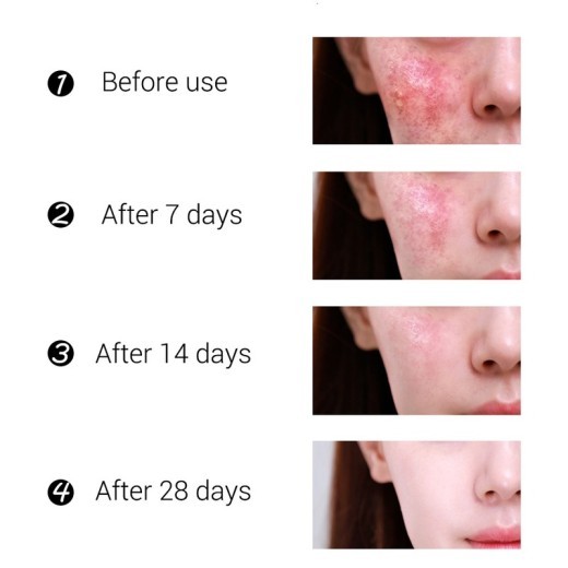 RtopR mango acne cream