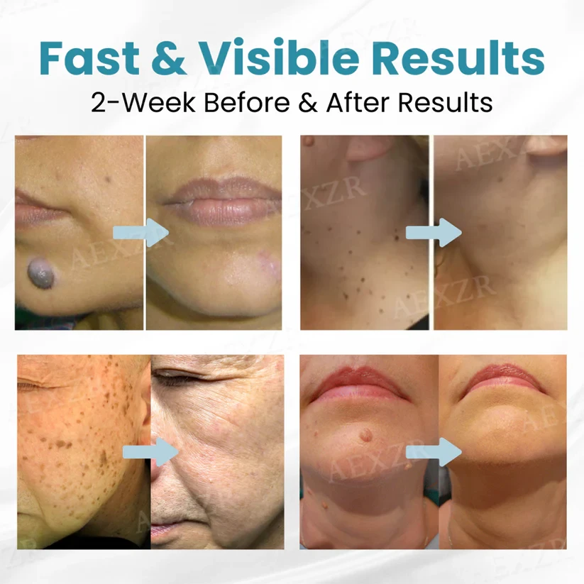 Bikenda Non-Invasive Mole and Wart Removal Laser Pen