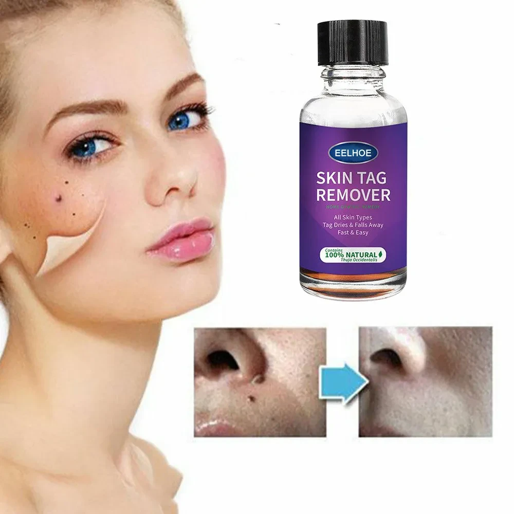 Foreign Trade Cross-Border Eelhoe Skin Verrucous Remover